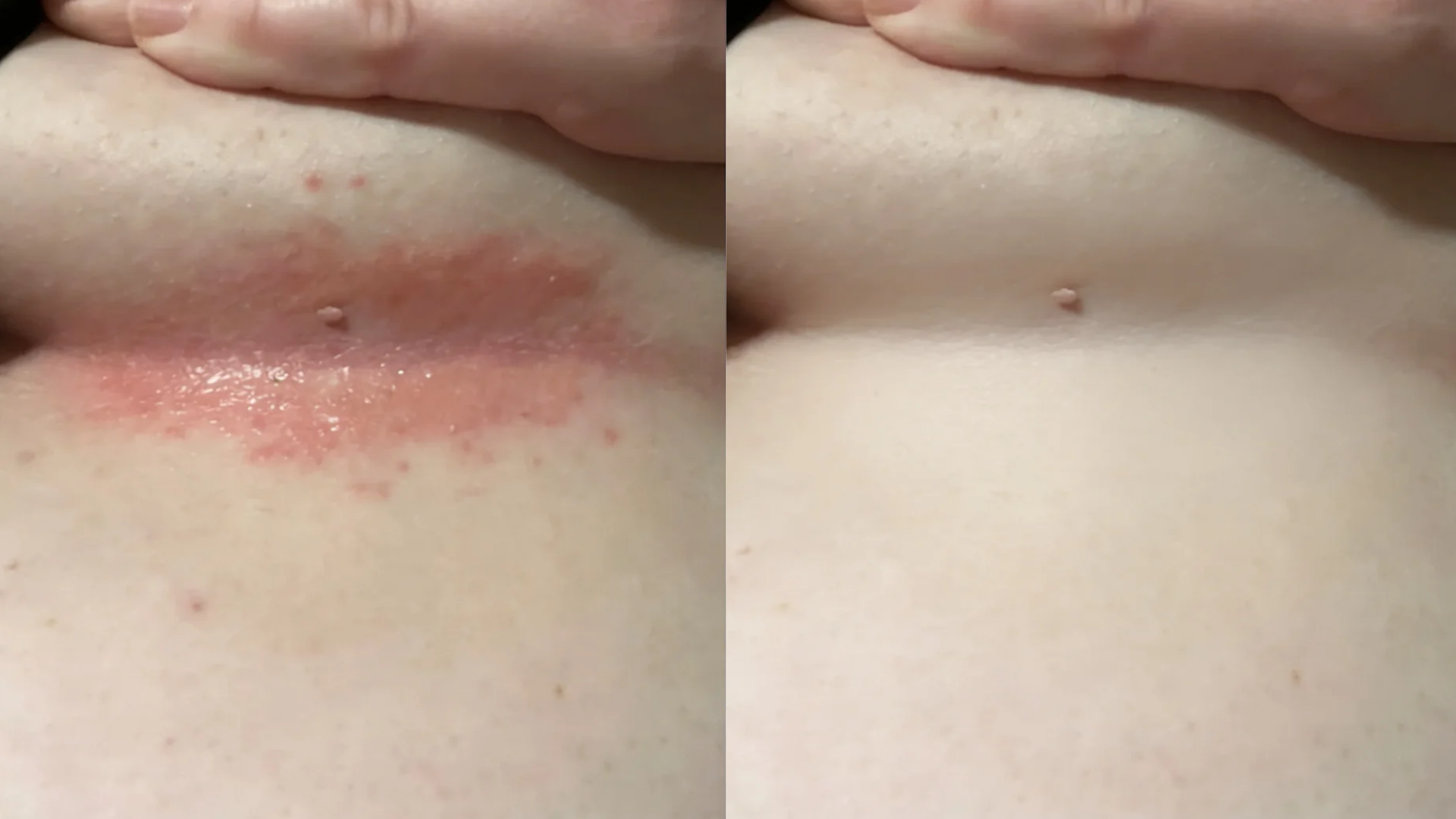 VOANA Anti-Friction Stick before and after — skin fold rash relief, customer 5