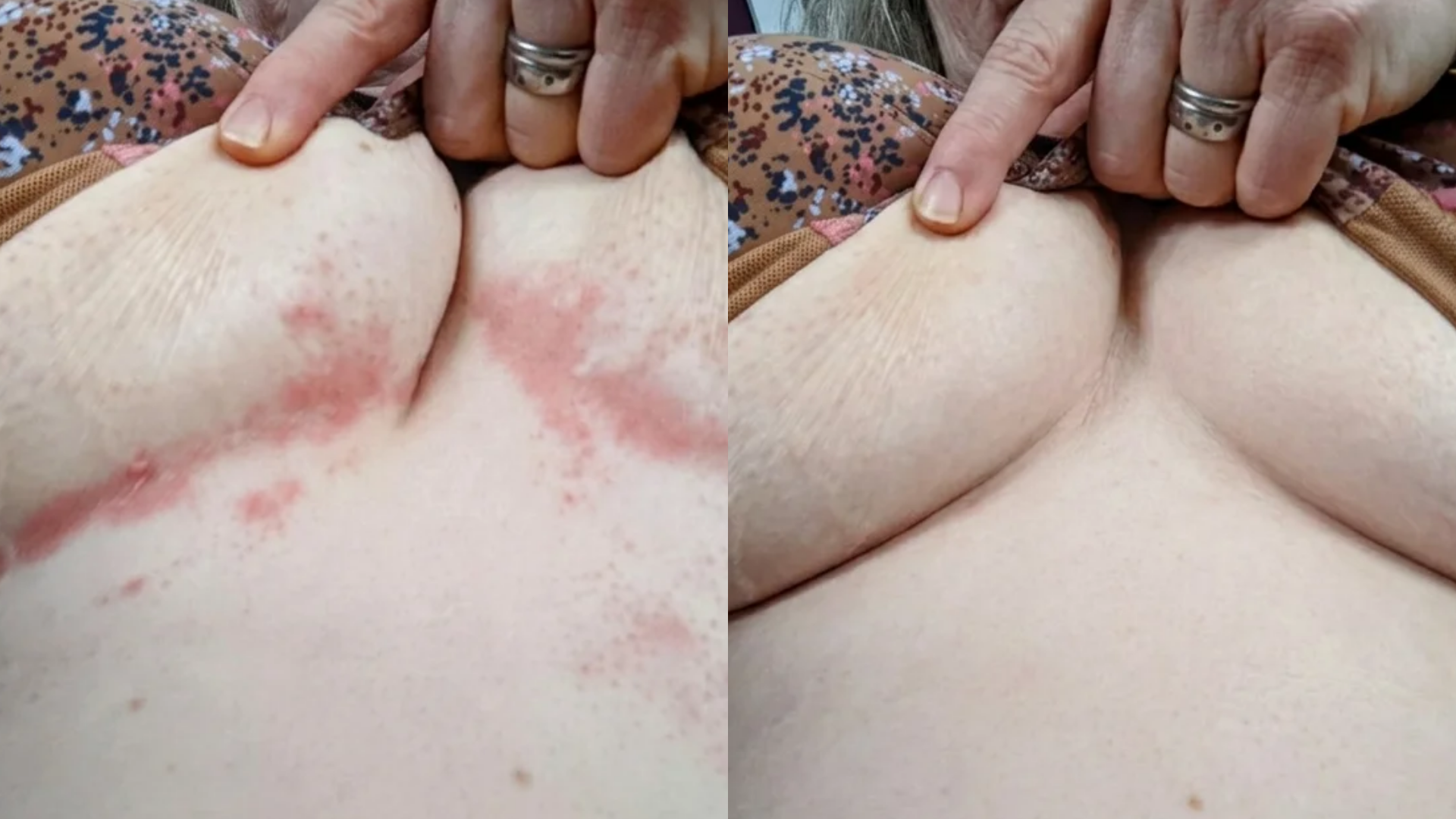 VOANA PDRN Repair Cream before and after — skin-fold rash, customer 1