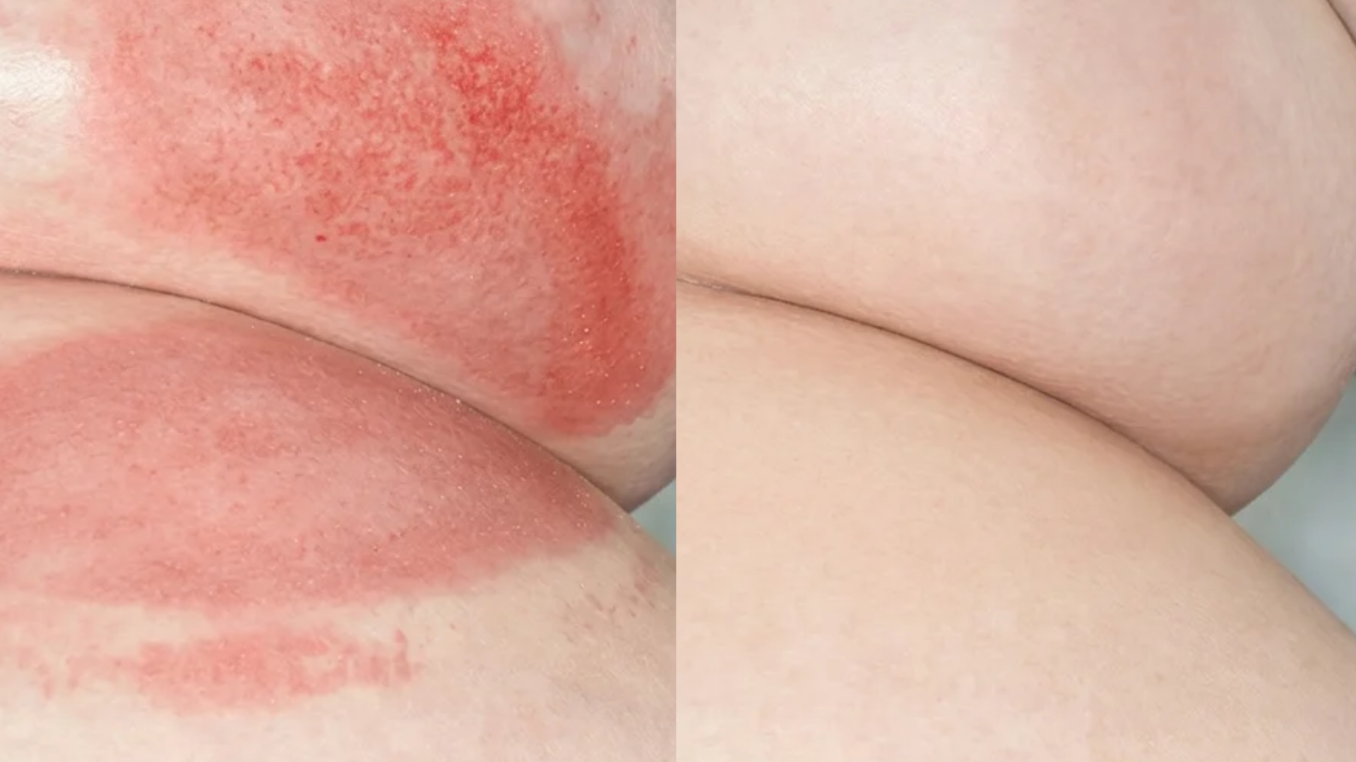 VOANA PDRN Repair Cream before and after — skin-fold rash, customer 2