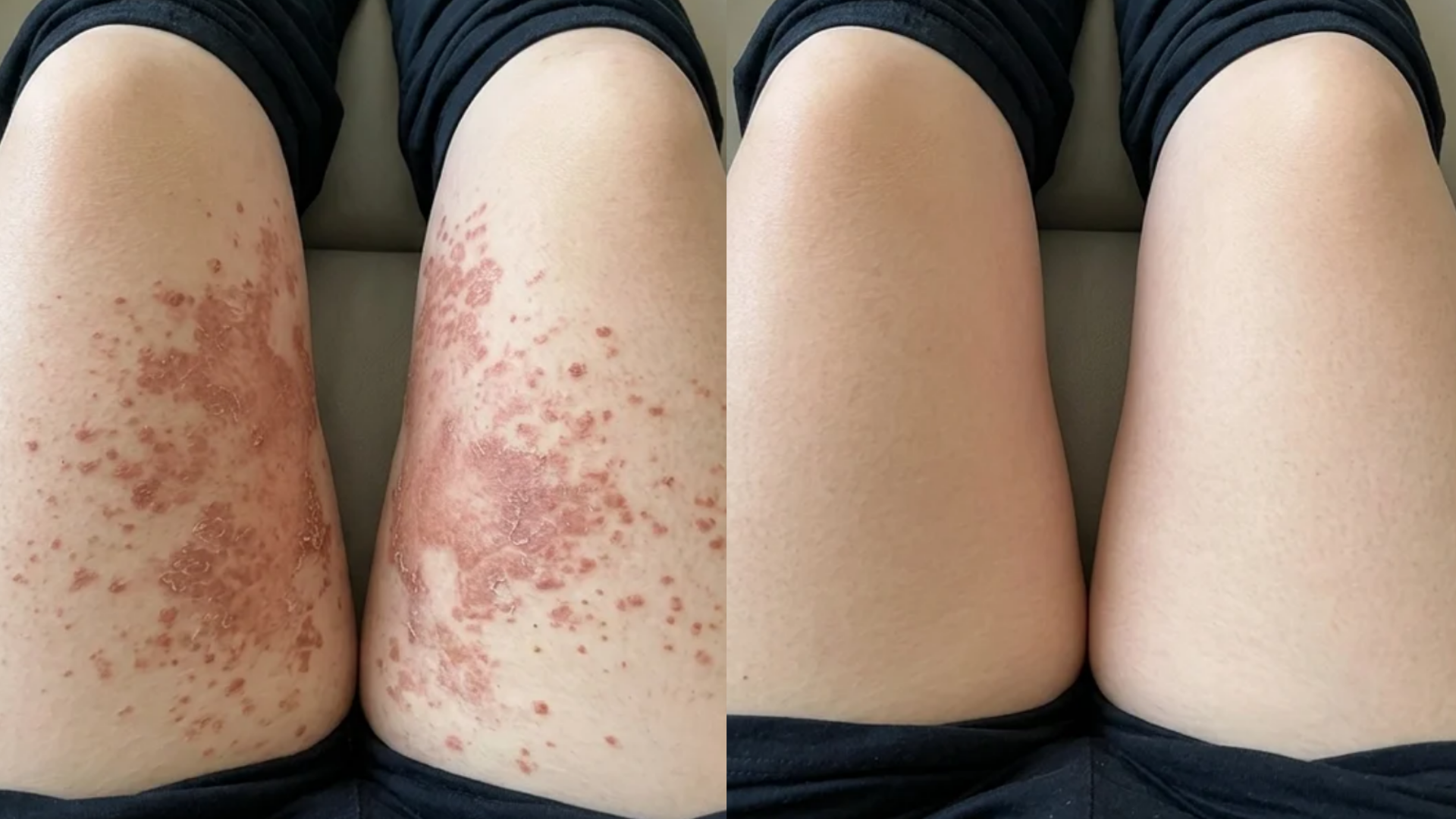 VOANA PDRN Repair Cream before and after — skin-fold rash, customer 3