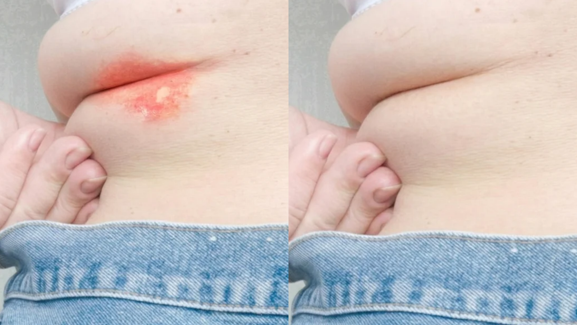 VOANA PDRN Repair Cream before and after — skin-fold rash, customer 6